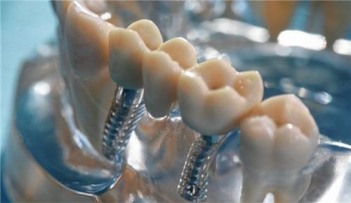 Auch moderne Implantatlösungen werden bezuschusst. Die gesetzlichen Krankenkassen zahlen den befundorientierten Festzuschuss. Fotos prodente e.v.