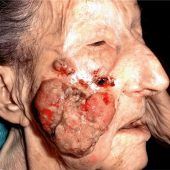 Die wundersame Wundheilung