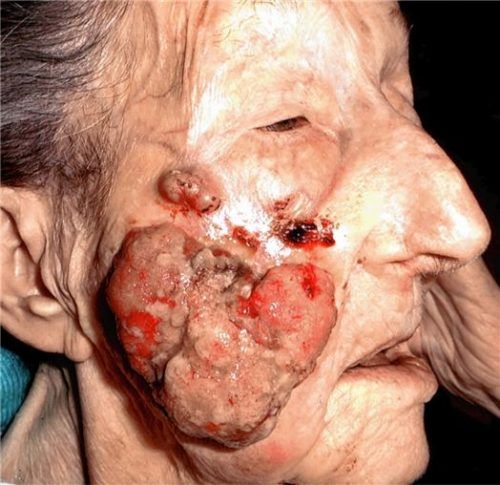 Faustgroß war der Hautkrebs auf Anna Kroihers Wange (linkes Bild). Die 98-Jährige war stark beeinträchtigt von dem malignen melanozytären Tumor. Als es vor drei Jahren mit ein paar roten Flecken anfing, wollte sie keine OP aus Angst vor dem Narkoserisiko und einer Infektion. Und weil eine offene Wunde geblieben wäre. Doch dieser „schwere blutende Sack“ nahm ihr die Lebensqualität. Dr. Reda Agha wagte als Einziger die Entfernung unter lokaler Betäubung. Ein halbes Jahr später ist nur noch eine kleine Kruste zu sehen (rechtes Bild). Die Wunde ist trocken und abgeheilt.