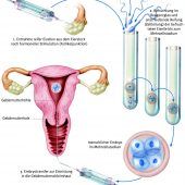 Von der Ei-Entnahme bis zum Embryonen-Transfer: So geht eine künstliche Befruchtung