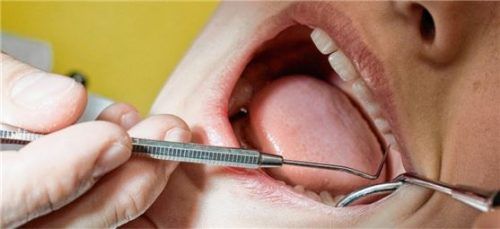 Zahnärzte sollen bei Kindern, stillenden und schwangeren Frauen auf Amalgam verzichten.Foto dpa