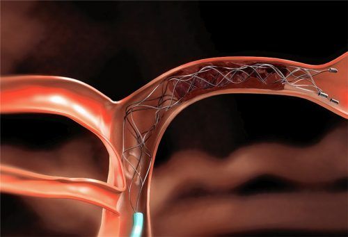 Bahnbrechende Methode:  Bei der Thrombektomie wird ein Katheter ins Gefäßsystem des Gehirns eingeführt, mit dessen Hilfe das Gerinnsel entfernt wird. Foto dpa