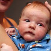 Neurodermitis: Hilfe für kranke Haut