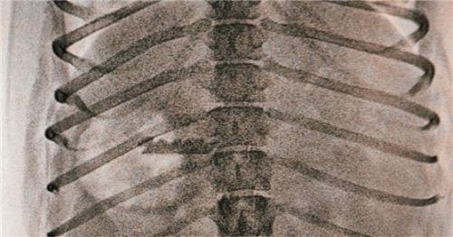 Klar erkennbar: die Rasierklinge auf der Röntgenaufnahme.