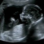 Pränataldiagnostik: Eine Übersicht über wichtige Methoden