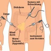Blinddarm: OP mit Minischnitten