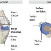 Voll aufs Knie: Rettung für den Meniskus