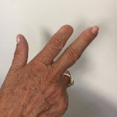 6000 Euro für zwei Fingerkuppen