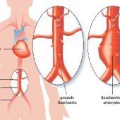 Wenn die Bombe im Bauch platzt