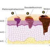 Eine tückische Krankheit – so erkennt man Hautkrebs frühzeitig