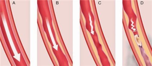In einer gesunden Arterie fließt das Blut ungehindert. Kommt es jedoch zu Ablagerungen, verengt sich die Gefäßwand und der Blutfluss wird geringer – bis es schließlich zum Verschluss kommt (von links).