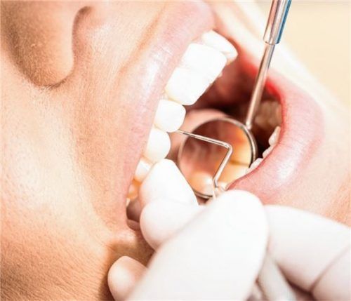 Mit einem PSI-Test misst der Zahnarzt die Tiefe der Taschen. Das ist der Bereich zwischen Zähnen und Zahnfleisch. Das Zahnfleisch entzündet sich schleichend und bleibt auch in diesem Zustand lange schmerzfrei. Foto proDente e. V./Peter Johann Kierzkowski