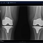Neue Knie: Jetzt radelt er bis an die Ostsee