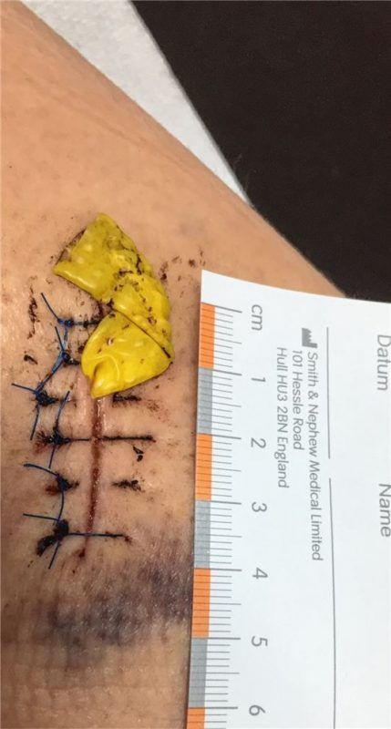 Eine rund vier Zentimeter große Narbe hinterließ der Biss der Hündin bei der Joggerin aus Rottau. So sah die Wunde Anfang April aus.