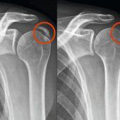 Neue Therapie gegen die Kalkschulter