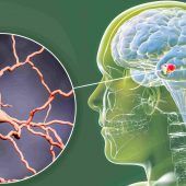 Parkinson – so kann man die Gehirnkrankheit bremsen