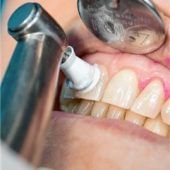 Zahnfleischbluten immer ernst nehmen