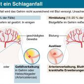 Der GAU im Gehirn: So erkennen Sie die Vorboten eines Schlaganfalls