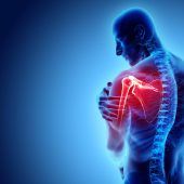 Schmerzfalle Schulter