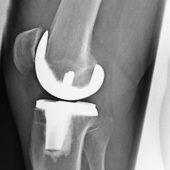 Gelenkersatz: Nicht jede Operation läuft nach Plan