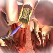 Eingriffe an den Herzklappen