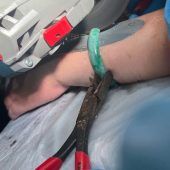 Notfall: Feuerwehr trennt Armreif ab