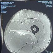 Djokovic: MRT-Bild vom Muskelriss
