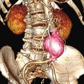 Vorsorge verhindert Schlagader-Blitztod