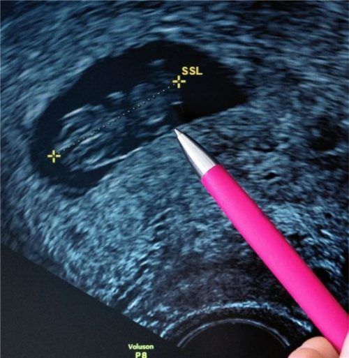 Eine Frauenärztin deutet auf den Kopf eines Fötus im Ultraschall, dessen Scheitel-Steiß-Länge (SSL) von 24,2 Millimetern auf eine Schwangerschaftsdauer von etwa 9 Wochen hinweist.Foto DPA