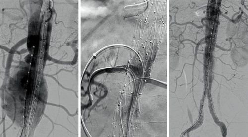 Ein Aneurysma vor, während und nach der Operation in Wasserburg. Fotos Romed Wasserburg