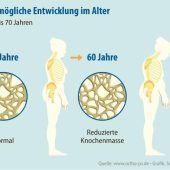 Risiko Knochenschwund: Das hilft den Patienten im Alltag