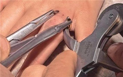 Nur mit einem Spezialwerkzeug konnte die Feuerwehr den Ring vom Finger lösen. Foto Feuerwehr