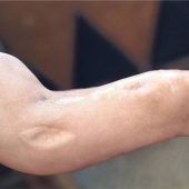 HeimatLichter ermöglicht OP für Asma