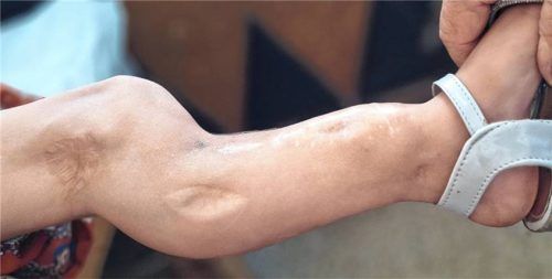 Den OVB-Lesern sei Dank: Mit ihren Spenden im Rahmen der OVB-Weihnachtsspendenaktion 2025 „HeimatLichter“ machen sie es möglich, dass Asma (7) aus Afghanistan in der Orthopädischen Kinderklinik in Aschau operiert werden kann. Foto Friedensdorf International